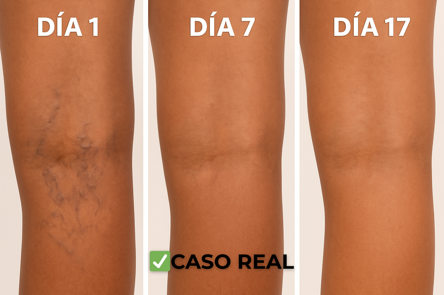 Parches Naturales para Varices y para las Piernas Cansadas - VeinPatch™