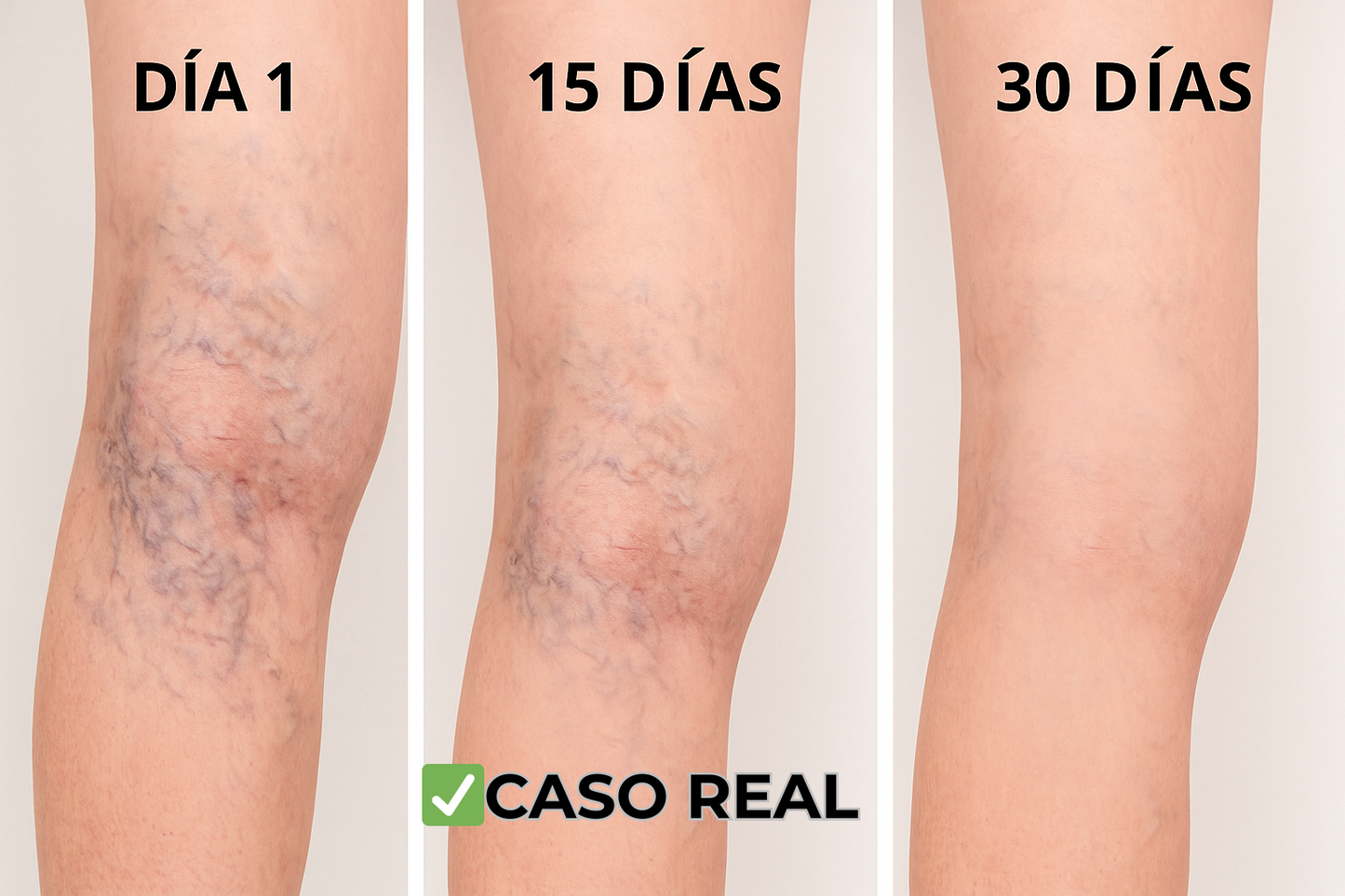 Parches Naturales para Varices y para las Piernas Cansadas - VeinPatch™